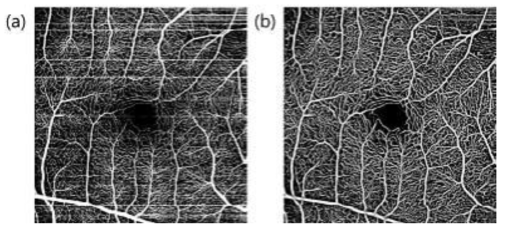 400kHz VCSEL OCT로 획득한 혈관 영상의 영상처리 알고리즘 적용 전(a)과 적용 후(b)의 비교