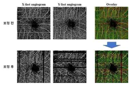 Cross-scan OCT를 통해 획득한 수평 스캔(X-fast Angiogram) 영상과 수직 스캔(Y-fast Angiogram) 영상을 동시에 획득한 뒤 두 영상의 정합을 통해 최종적으로 안구의 움직임이 보정된 영상을 획득함