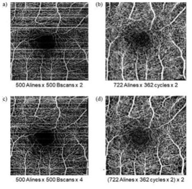 본 연구진이 개발한 OCTA 시스템으로 획득한 망막에서의 혈관영상. 일반적인 Raster 스캔 패턴으로 획득한 영상(a, c)과 Lissajous 스캔 패턴으로 영상보정한 영상(b, d)