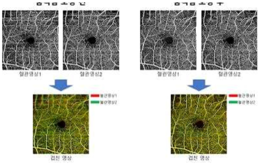 본 연구진이 개발한 400kHz OCTA 시스템으로 획득한 두 장의 혈관 영상을 보정하기 전과 후 영상. 스캔 범위는 6mm x 6mm이며, 1000 (Aline) x 1000 (Bscan) x 4 의 raster scan 패턴으로 획득함