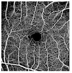 망막에서의 6mm x 6mm 크기의 혈관영상.\