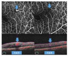 치료 전 관찰되는 미세혈관류가 치료 후 소실 된 영상