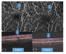 치료 전 관찰되는 미세혈관류가 치료 후 크기가 감소된 영상