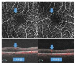 치료 전 후 관찰되는 미세혈관류의 크기 변화 영상