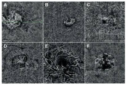 빛간섭 단층 혈관 조영술에서 나타나는 다양한 형태의 신생혈관