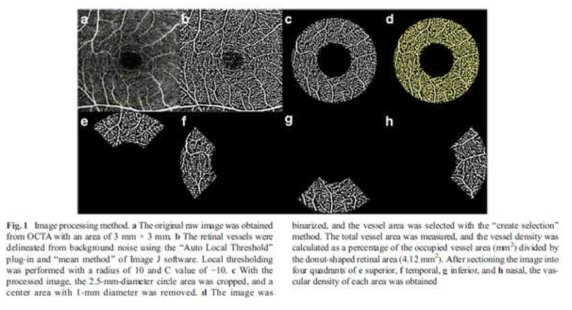 망막질환의 치료 후의 상태를 빛간섭 단층 혈관 조영술을 이용하여 촬영한 후 혈관의 변화를 평가하기 위한 방법을 고안, SCI에 게재
