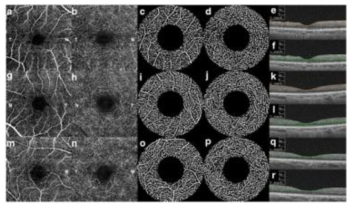 표층부와 심층부 망막 혈관 밀도 관찰 영상