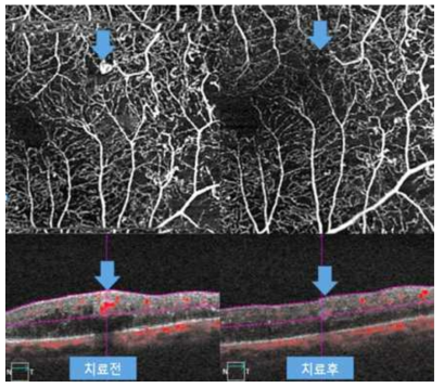 망막 미세혈관류의 소실
