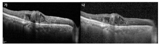 내측 망막변화의 OCT 영상
