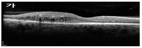 외측 망막변화의 OCT 영상