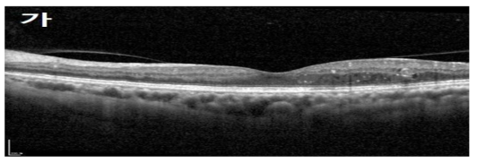 망막색소상피 변화
