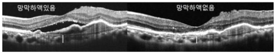 영상을 이용한 망막하액 유무 판별