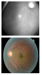 망막 모니터링용 안저카메라로 촬영된 안저사진 (위) 피실험자의 안저 적외선 이미지 (아래) 안저 가시광 이미지 예시