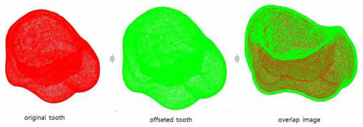 오프셋 치아의 모습(STL)