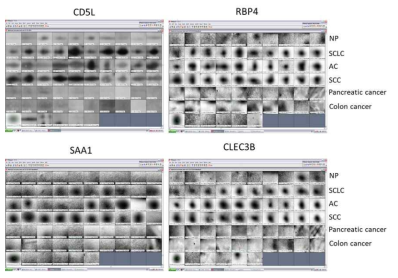 엑소좀 표지자 2-D 이미지 (I). NP, normal person; SCLC, small cell lung cancer; AC, adenocarcinoma ling cancer; SCC, squamous carcinoma cancer