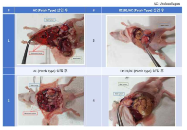 IO101/AC 이식제의 복강 내 암 전이 관찰