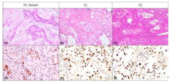 Patient’s pancreatic cancer tissue (a and d) and tissues form sequential implanted xenograft model (F1, b, and e/ F2, c and f) showed similar pattern of cancer morphology and strong nucleolin expression noted in prominent nucleaus of the pancreatic cancer cells