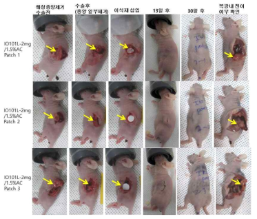 췌장암 외과수술 후 IO101L/AC Patch 이식 마우스에서 1개월 후 복강 내 전이 없음