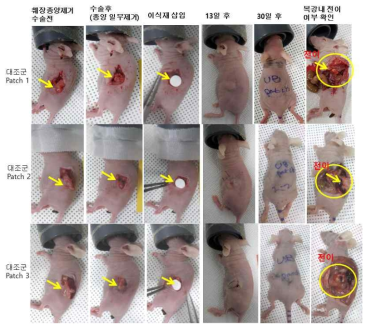 췌장암 외과수술 후 대조군 이식 마우스에서 1개월 후 복강 내 간, 횡경막 및 신장 등의 전이 관찰