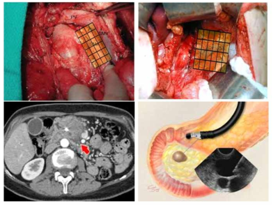 췌장암 수술 중 AAC(IO401)의 투여 모식도. 수술 전 영상으로 위치를 선정한 후 수술장에서 implant 하거나, 내시경을 통한 직접 주입도 가능함