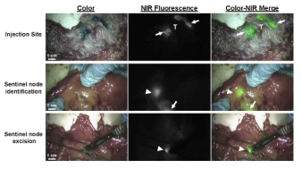 대장암수술에서 NIR 형광과 blue dye를 이용한 림프절의 영상화
