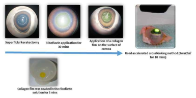 돼지 눈에서 riboflavin/UV-A 광화학적 가교를 실시하여 콜라겐 쉴드 부착 시스템 개발