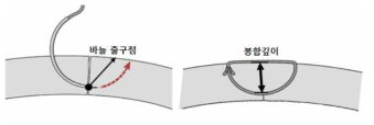 바늘 출구점 및 봉합깊이의 정의