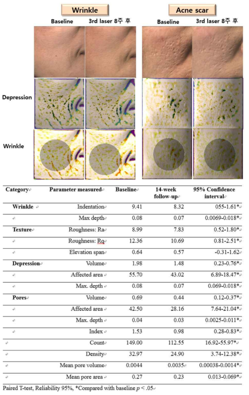 Antera 3D를 이용한 레이저 치료 전후 syrface profilometry 분석결과 사진(위) 및 각각의 skin parameter의 유의성 검사 결과(아래)