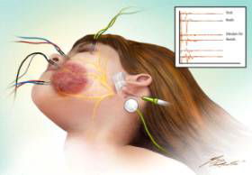 Facial Nerve Stimulation 개략도