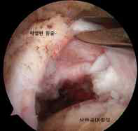 회전근 힘줄의 파열 (관절경 사진)