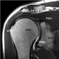 어깨관절 (MRI 영상)