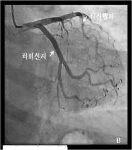 좌측 관상동맥 (좌전행지와 좌회선지)