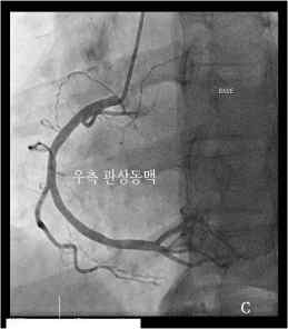 우측 관상동맥