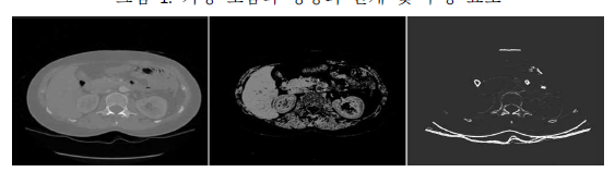 CT 영상의 초음파 변환 예시 - 원본CT영상, 스페클효과(speckle), 반사효과 (좌측부터)