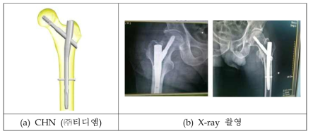 골수내고정막대 모식도 및 수술 후 X-ray 촬영 사진