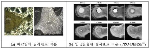 아크릴계 및 인산칼슘계 골시멘트 적용 비교