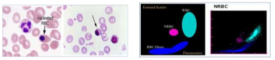 (좌) 혈액 도말, Wright 염색 후 NRBC, (우) flow cytometry에서 NRBC population