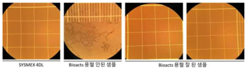 4DL 적용 후 적혈구 용혈상태를 현미경으로 확인