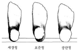 세장도 분석에 따른 발 유형