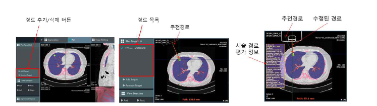 바늘 삽입경로 추가 및 삭제 기능 (경로 추가/삭제 버튼(좌), 경로 목록 및 추천 경로(중앙), 시술경로 평가 정보 표시(우))