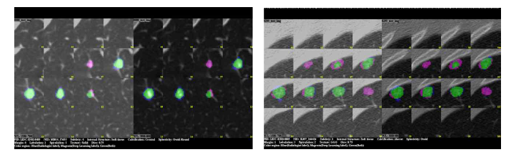 종괴 분할 결과 (Blue (Radiologist Label), Magenta (Deep Learning Label), Green (Both))