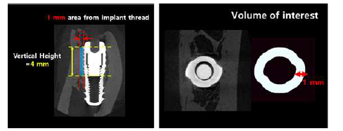 식립된 임플란트의 Volume of interest(VOI) 영역 설정