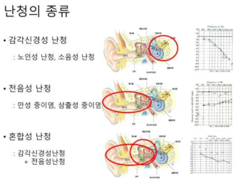 난청의 종류