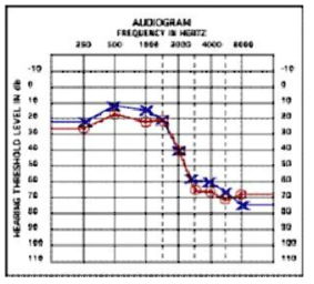 소음성 난청에서의 순음청력도 결과
