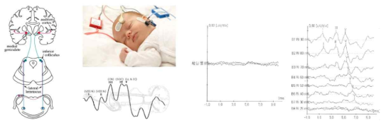 소아에서의 청력측정을 위한 성유발반응검사 (Auditory brainstem response, ABR)