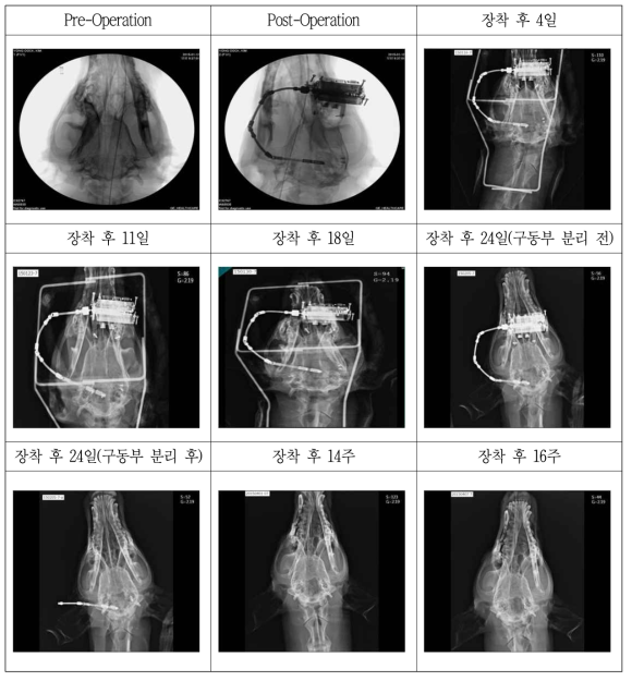 시간 경과에 따른 융합형 골 신장기 장착 전, 후 방사선 사진촬영