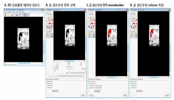 TERA RECON Workstation을 이용한 골 형성 분석결과