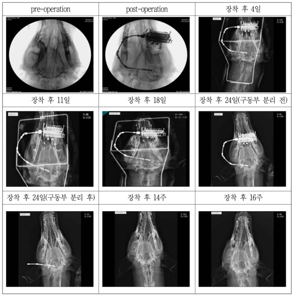 융합형 골 신장기 및 연속 골 신장 제어시스템 정상 위치 case