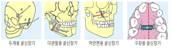 여러 가지 수술에 사용되는 골신장기 예