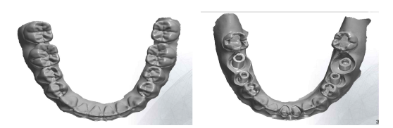Standard Tessellation Language files of mandibular arch (dentiform): (Left) normal condition; (Right) implants, abutments, and inlays